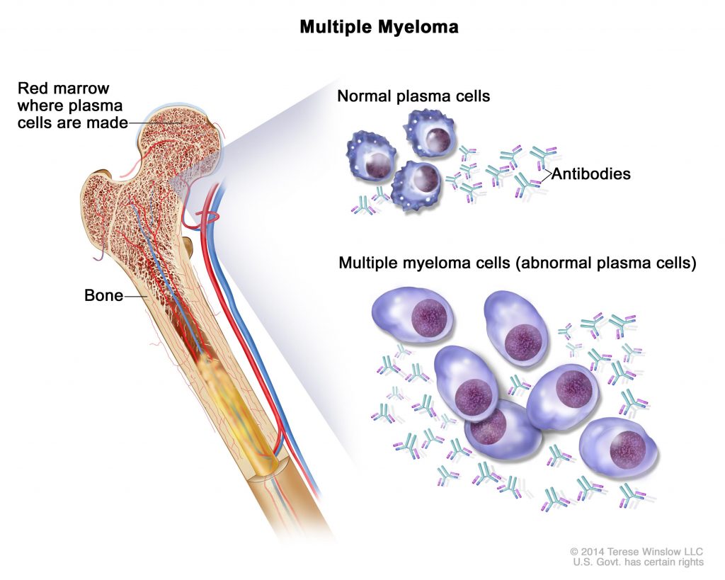 Bone Marrow Neoplasm - MyBioSource Learning Center
