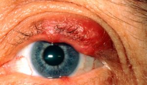 eyelid diseases