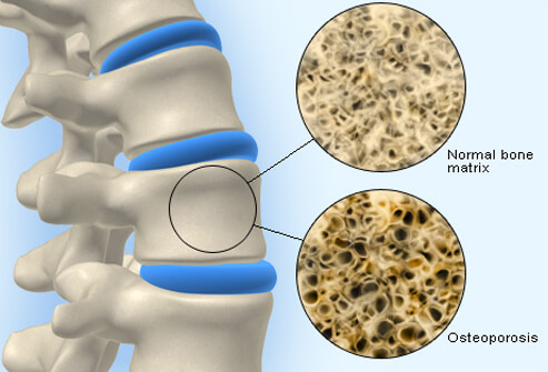 Osteoporosis more about healthy foods and exercises than pills and supplements